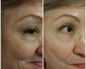 Tensor Facial - Botox en Crema