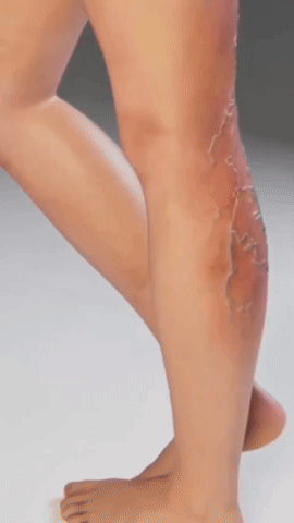 Parche para Venas Varices - VenaCare Patch – Siete Vidas