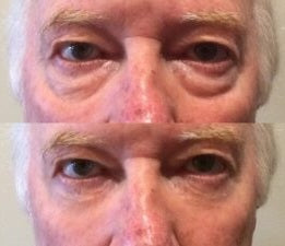 Tensor Facial - Botox en Crema