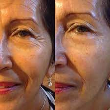 Tensor Facial - Botox en Crema