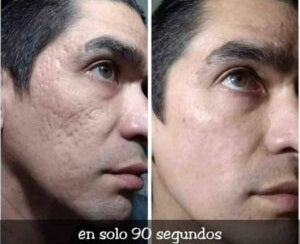 Tensor Facial - Botox en Crema