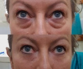 Tensor Facial - Botox en Crema