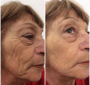 Tensor Facial - Botox en Crema
