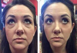 Tensor Facial - Botox en Crema